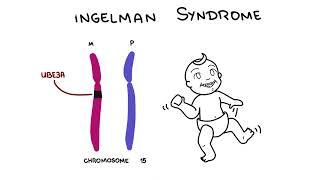 Angelman Syndrome