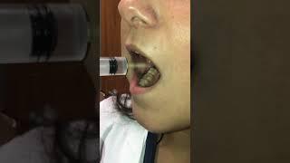 Irrigation of Wisdom Tooth Sockets