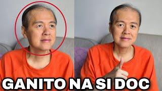 ITO NA NGAYON si Doc Willie Ong TULUYAN NG NALAGAS ang BUHOK NITO KALBO NA!