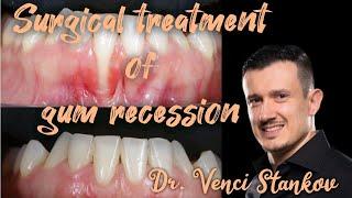 Surgical technique for treating gum recession. Dr. Venci Stankov