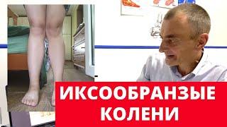 Диагностика ног по фотографии | Иксообразные колени, что делать?