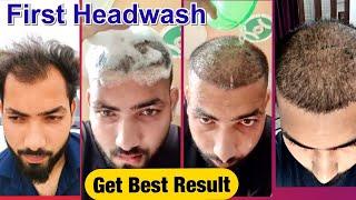 Case Study: Live First Headwash For Best Hair Transplant Result | Hair Transplant in india