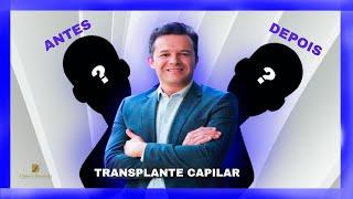 Resultados transplantes capilar! (Valeu a pena!)