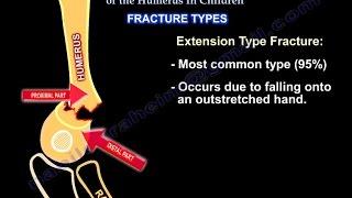 Supracondylar Fractures Of The Humerus In Children