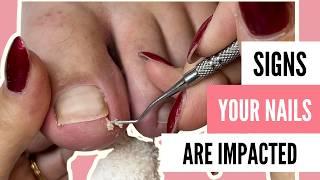 Foot Restoration: Fixing Thick Toenails, Calluses, and Athlete’s Foot | Meticulous Manicurist
