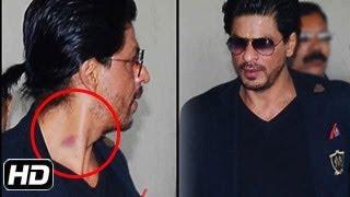 Shahrukh Khan Shocking LOVE BITE on His Neck