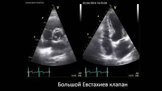 Аритмии и прочие странности ЭхоКГ коллекция из твиттера