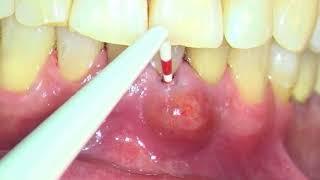 CBCT scan reveals massive infection