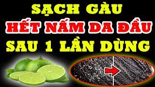 Trị Gàu Nấm Da Đầu Cỡ Mấy Cũng Hết Ngay Lập Tức, Chỉ Với Tuyệt Chiêu Đơn Giản SAU MỘT LẦN THỰC HIỆN