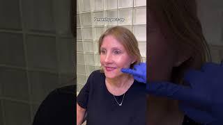 Facelift Transformation #bestfaceliftnyc #nycfacelift #njfacelift #faceliftbeforeandafter #facelift