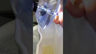 The wax plug with attachment issues..