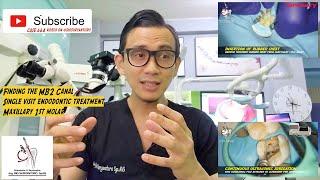 NEGOTIATE MB2 CANAL MAXILLARY 1ST MOLAR FROM ULTRASONIC TO WARM HYDRAULIC OBTURATION - ENDODONTIC 