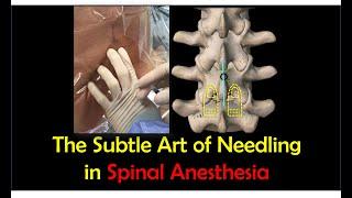 Landmark-Guided Midline Spinal Anesthesia (Step-by-Step Technique)