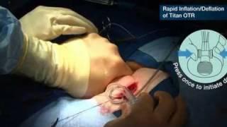 Titan OTR Infrapubic Surgical Procedure - Part 5