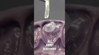 Dental motivation. Direct composite restoration veneers. #dental #dentistry #dentaltreatment