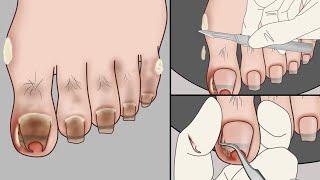 ASMR Ingrown Toenail Removal Treatment AnimationStrong Satisfaction   Mengs Stop Motion