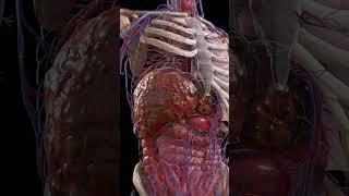 Cirrhosis: Liver Under Siege  #3dmodel #meded #anatomy