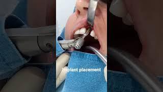 Full Implant placement procedure link in description #dentist #implant #teethtalk  #dentalimplants