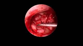 Endoscopic Composite Cartilage Tympanoplasty_Dr Nirmal Patel