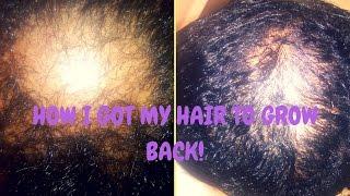 HOW I GOT MY HAIR TO GROW BACK!!!