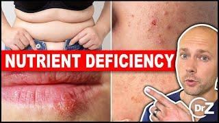 5 Common Nutrient Deficiencies In Modern People