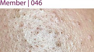 Acne Treatment Huong Da Nang# 046 | Member | 2023