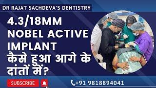 Anterior Implant Placement | Nobel Active Dental Implants by Dr Rajat Sachdeva Delhi Dentist