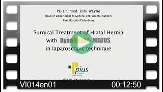 DynaMesh®-HIATUS - OR-Video: Surgical Treatment of Hiatal Hernia in Laparoscopic Technique