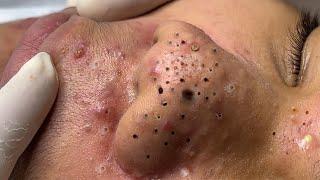 Big Cystic Acne Blackheads Extraction Blackheads & Milia, Whiteheads Removal Pimple Popping # 1610