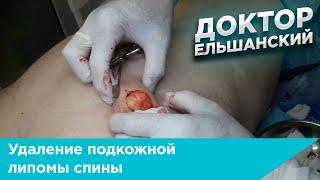 Удаление подкожной липомы спины