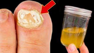 THIS is 100 times more EFFECTIVE than other home remedies to get rid of Nail Fungus