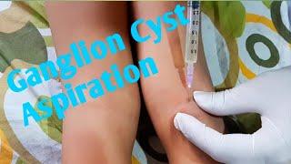 Ganglion cyst aspiration || #whatilearntoday || Treating ganglion cyst