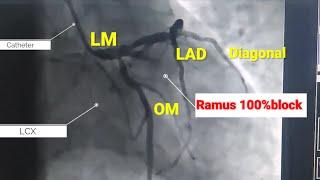 Acute heart attack ll Stenting to Ramus artery ll 100% blocked ramus artery