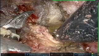 TORS (Robotic excision of Parapharyngeal mass) by Dr Nitin Sharma