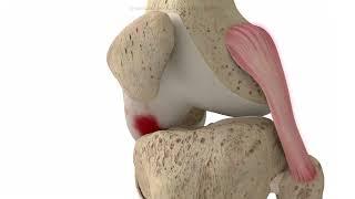 Kinematic Alignment 3D Video animation showing the main steps of TKA procedure