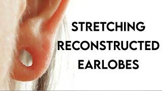 Stretching Reconstructed Earlobes