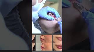Lip Filler #filler #aesthetictreatments #klinikkecantikan