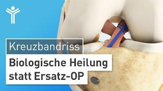 Kreuzbandriss biologisch heilen: DIE Alternative zur Kreuzbandersatz-OP