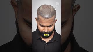 Best Hair Transplant Results | Latest Fue Technique #shorts #viral #hair transplant