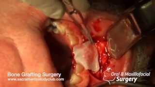 Bone Grafting Case