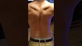#deformed #muscles #muscledevelopment #rare
