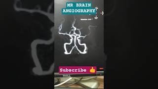 MR BRAIN ANGIOGRAPHY #mri #angiography #mritech #mriscan #xray #ct #anatomy #neuroscience