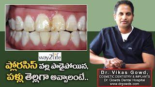 Best Dental Fluorosis Treatment | Fluorosis Causes | Fluorosis Prevention | Dr VIKAS 3 | way 2 life