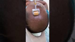 PRP - Best hair loss treatment | Hair loss treatment | derma roller hair regrowth | Skinaa Clinic