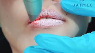 Trẻ Hóa, Săn Chắc, Hồng Môi Tự Nhiên - Lips Rejuvenation With Laser Fotona 4D