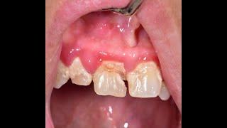 [5] Live root canal procedure on infected tooth