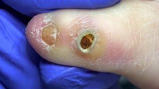 A flower bloomed on the toe, clearing the toe wart【Doctor Liu Pedicure】