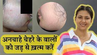 Facial Hairs ka Permanent Solution | Remove Facial Hair Hirsutism Permanently | Dr. Upasana Vohra