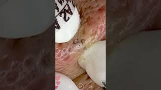 Skincare | Blackheads Removal #494 #tweezers skincare #blackheads blackheads