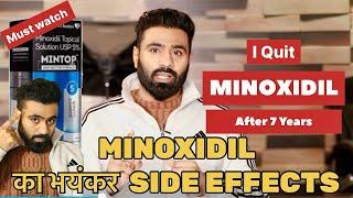 Minoxidil for Hairfall | My 7 Years Hair Transplant Result | How to Use minoxidil for Best Result